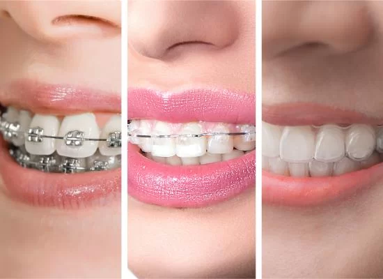 Orthodontic Braces and Invisible Aligners Meerut